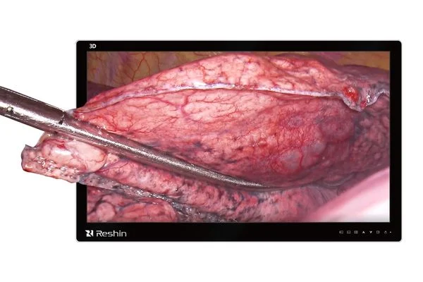 Monitor Reshin 3D para cirugía mínimamente invasiva